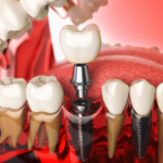 How Dental Implants Can Restore Your Smile and Confidence