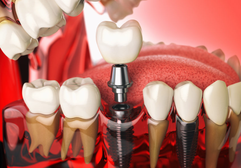 How Dental Implants Can Restore Your Smile and Confidence