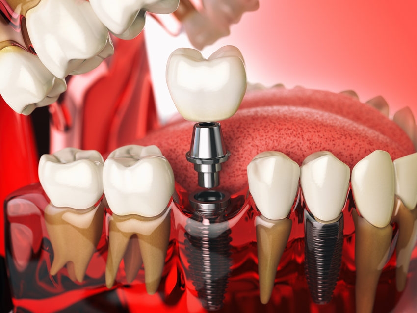 How Dental Implants Can Restore Your Smile and Confidence